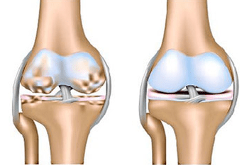 Healthy joint and arthrosis