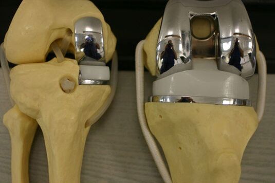 Variants of endoprosthetics of the knee joint