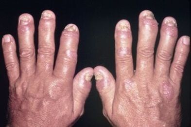 Why the joints of the fingers hurt