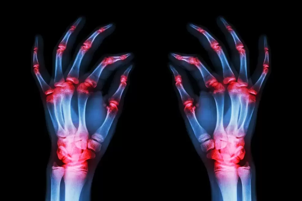 arthrosis of the finger joints