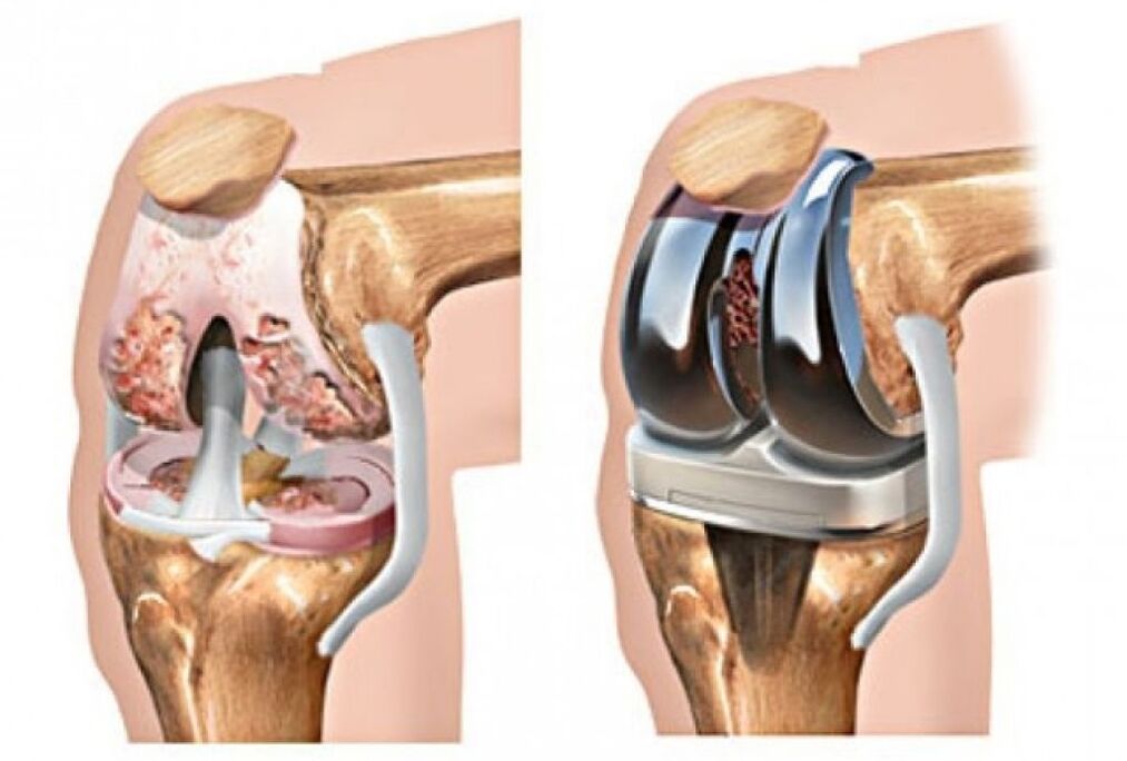 knee arthroplasty for arthrosis